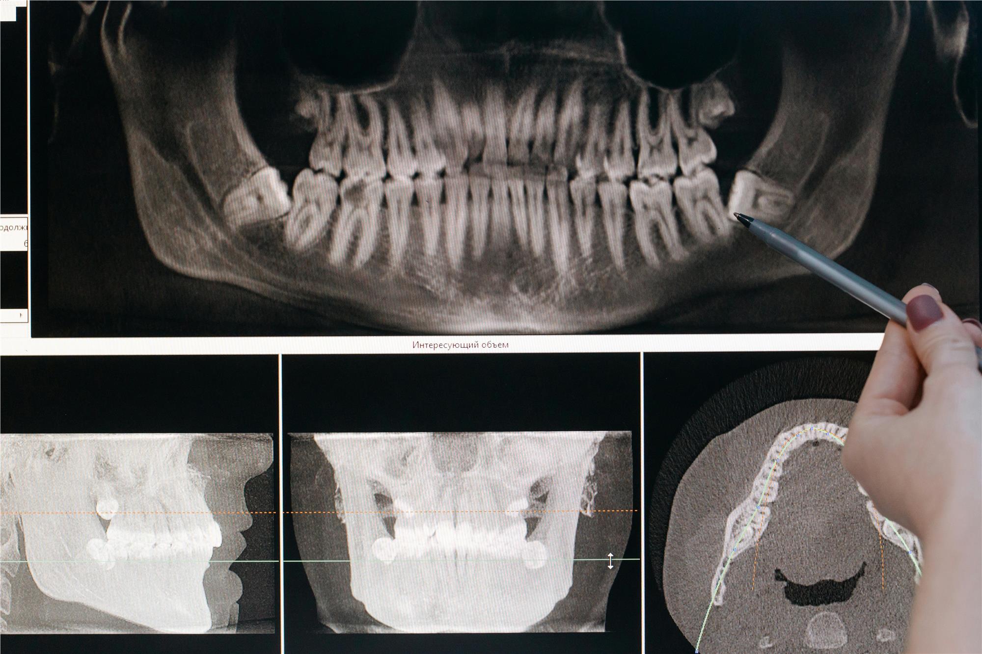 Dental X-rays
