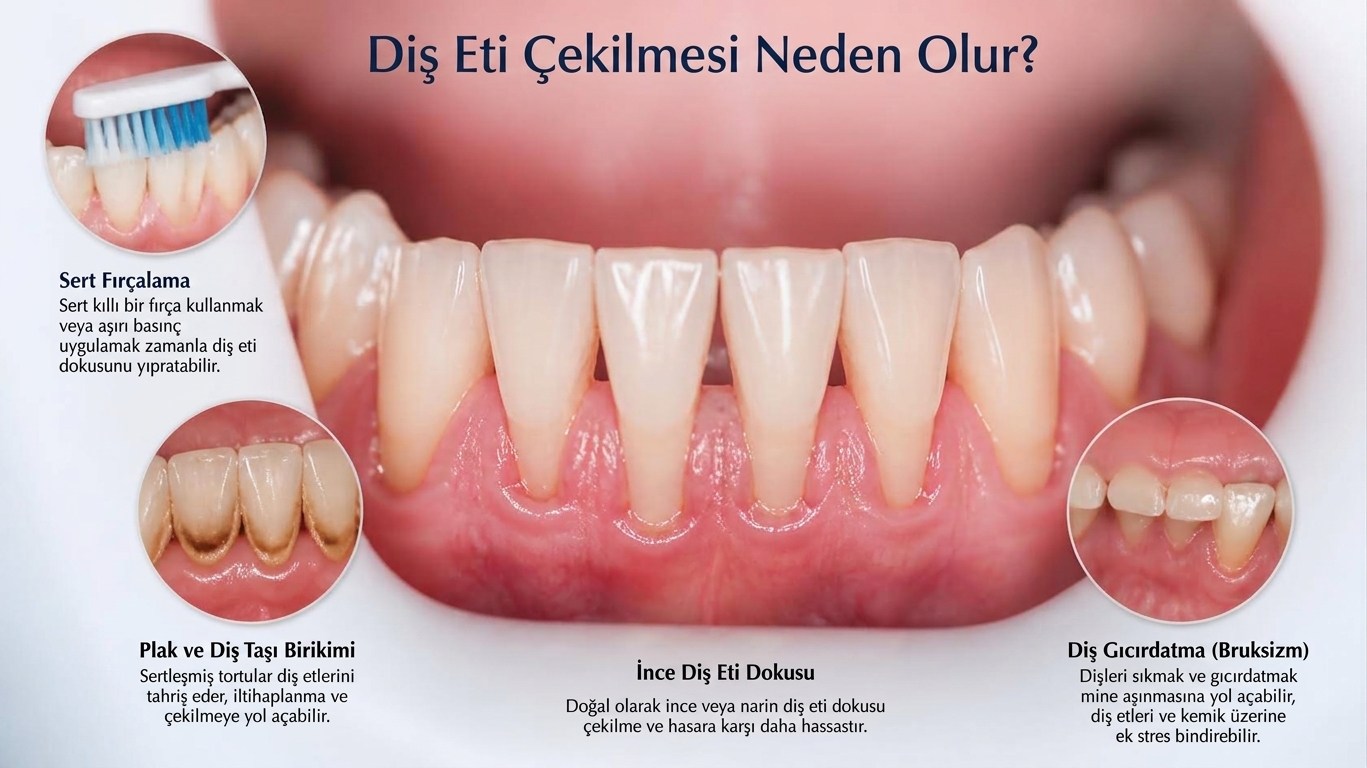 Diş Eti Çekilmesi Neden Olur?