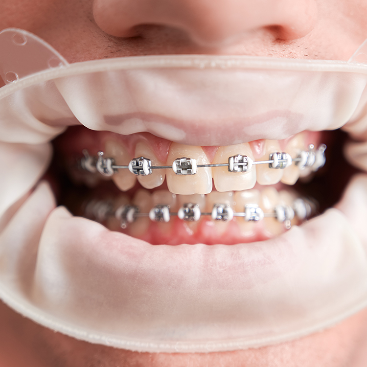 Splintleme nedir?